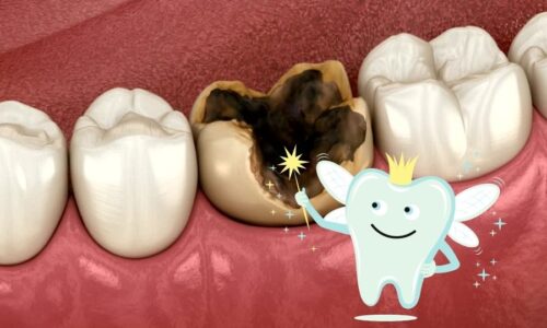 Tooth Decay: Getting Rid of It